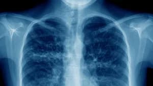 The Battle to Breathe